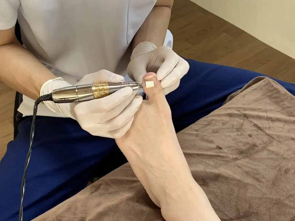 プレート装着前に専用機器で爪の表面を整える様子